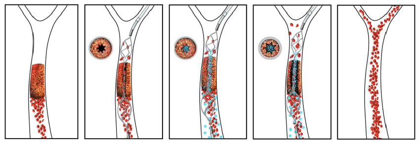 The new drug-device combination pairs an injectable clot-busting nanotherapeutic that targets blockages with an intra-arterial device that restores blood flow to obstructed vessels, as shown in this illustration.