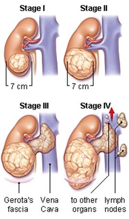 Etapas del cáncer de riñón