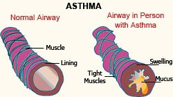 Asthma