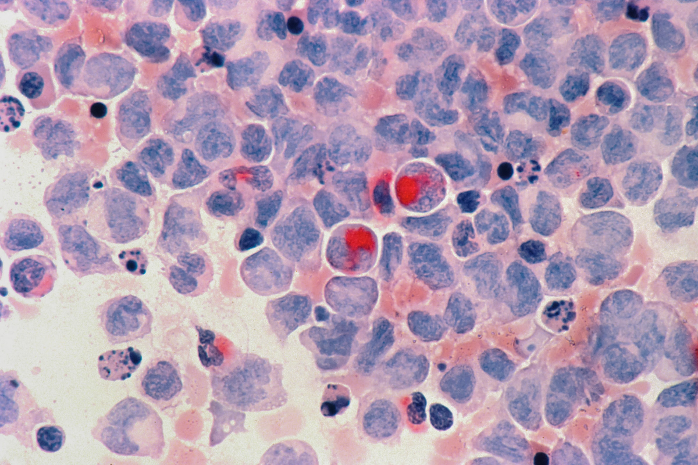 leukemia cell for patel SEO.jpg