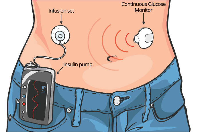 Insulin Pump Video