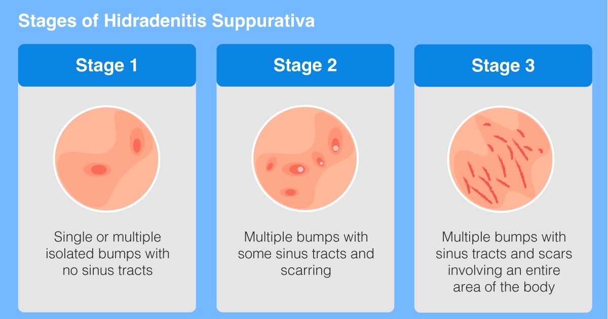  stages-of-hidradenitis-suppurativa.jpg