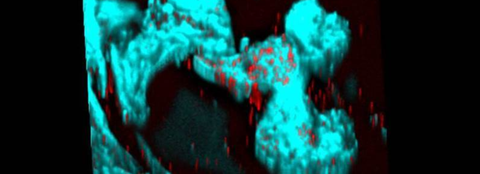 Amyotrophic Lateral Sclerosis, C9ORF72-associated