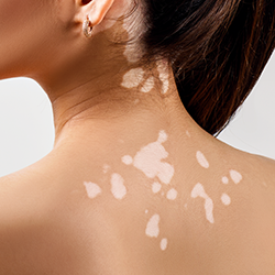 female-back-vitiligo.png