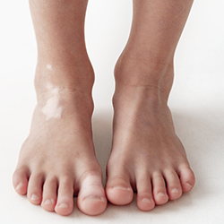 Vitiligo-feet.png
