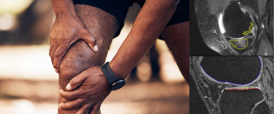 Left side: Closeup of man's knee being held while standing. Right side: two screenshots of MRIs showing bone marrow lesions and cartilage thickness measurements.