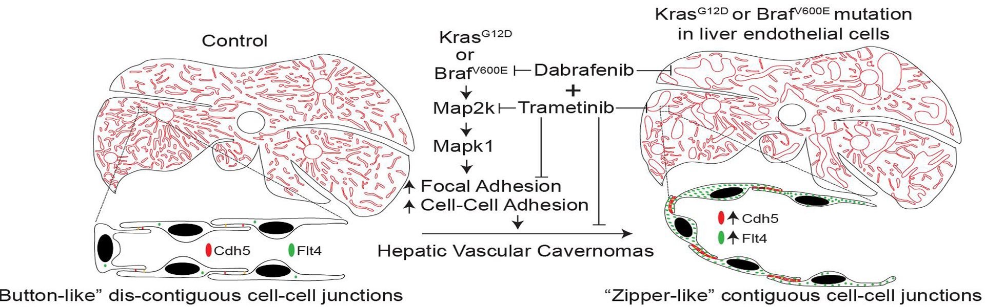Hepatic Vascular Cavernomas