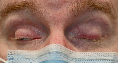 Patient unable to open eyelid