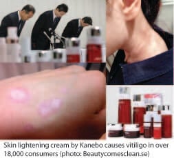 Kanebo cream induces vitiligo - Chemicals can cause vitiligo and also make it worse
