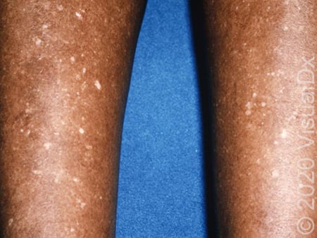 White Spots On Skin: Causes And How To Get Rid of Them