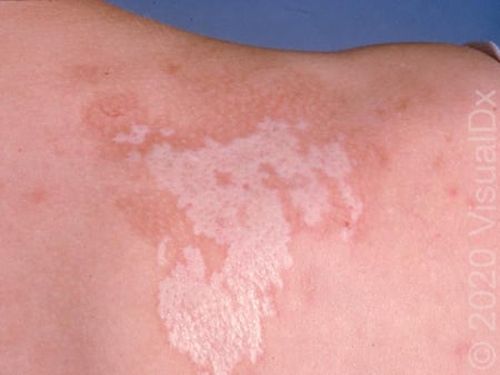 Morphea_40393.jpg