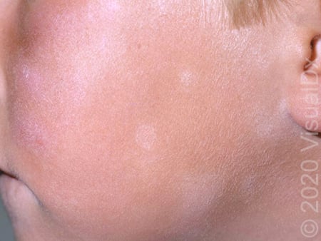 Pityriasis alba_75230.jpg