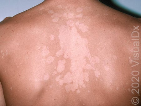 White Spots on Skin From Sun: What Are They?