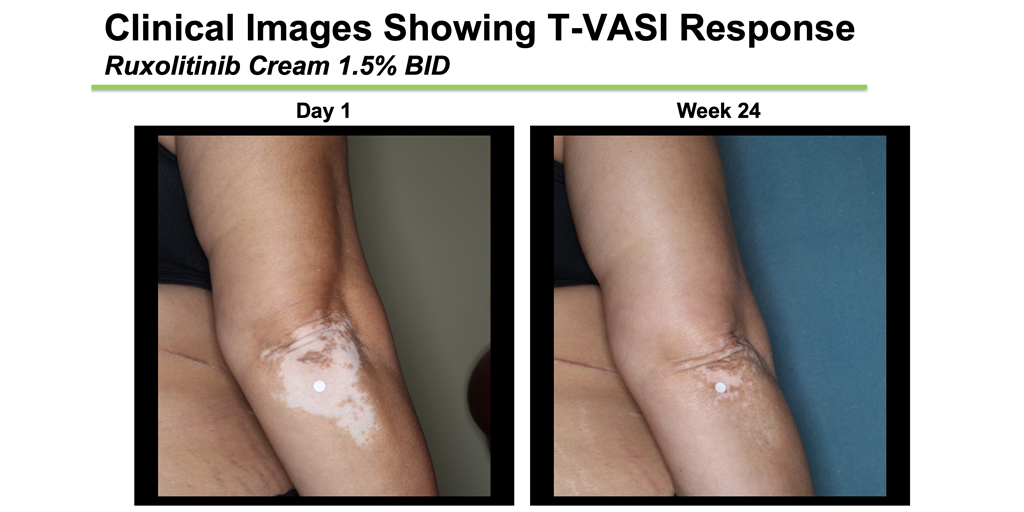 vitiligo-clinical-trial-results.png