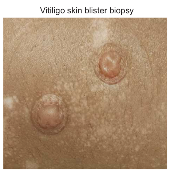 Skin Blister