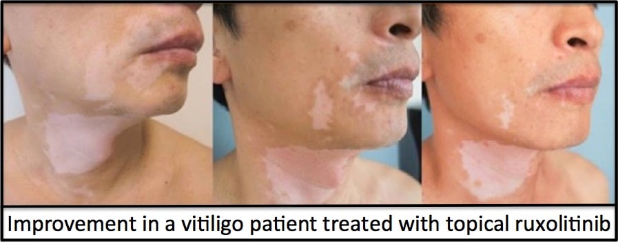 Vitiligo treatment